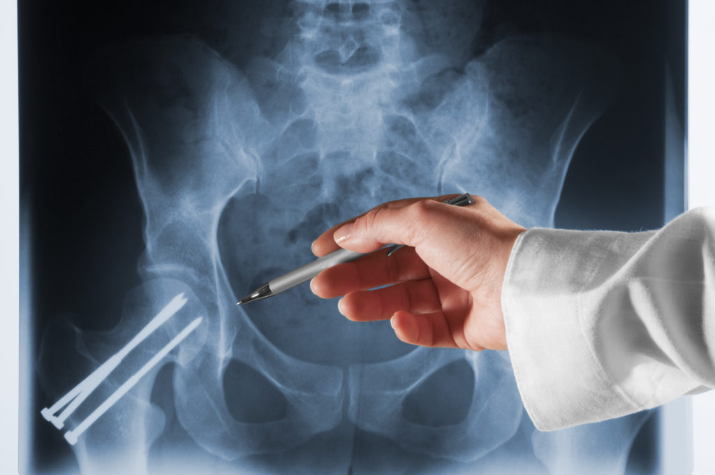 A doctor wearing a white medical coat is pointing at an Xray with a silver ballpoint pen. The Xray is on a light box and shows a human hip and pelvis. There are three long screws in the left hip which have been inserted to repair a broken bone. The doctor points to the screws to illustrate the repair. The Xray is blue.